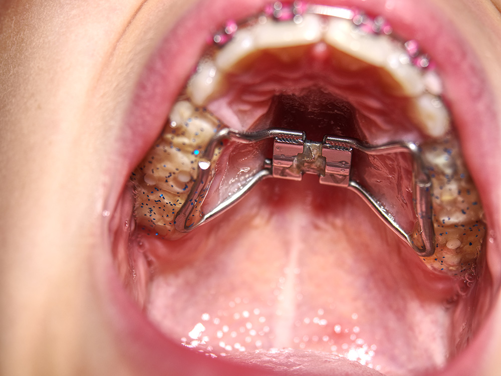 Jaw Expansion